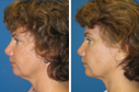 Before & After Photos